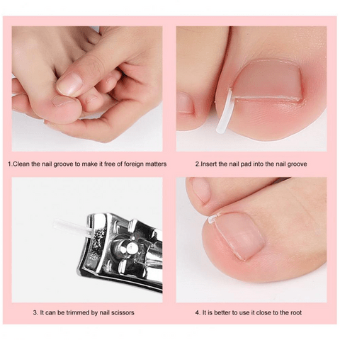 3 main 10pcs toenail straightening ingrown correction tool nail patch sticker foot care nail corrector straightening clip